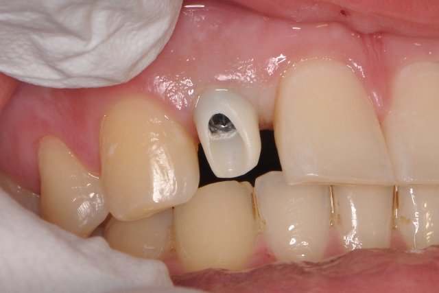 Implantatprothetik — Zahnersatz Düren, PS Dentaltechnik