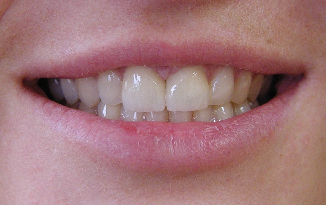 Vollkeramik & Ästhetik — Zahnersatz Düren, PS Dentaltechnik